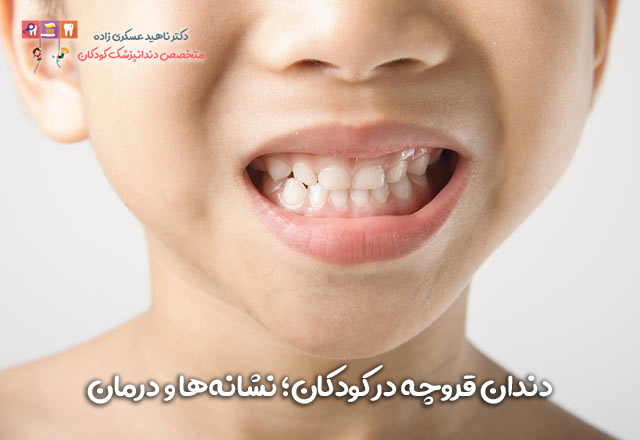 دندان قروچه در کودکان؛ نشانه‌ها و درمان